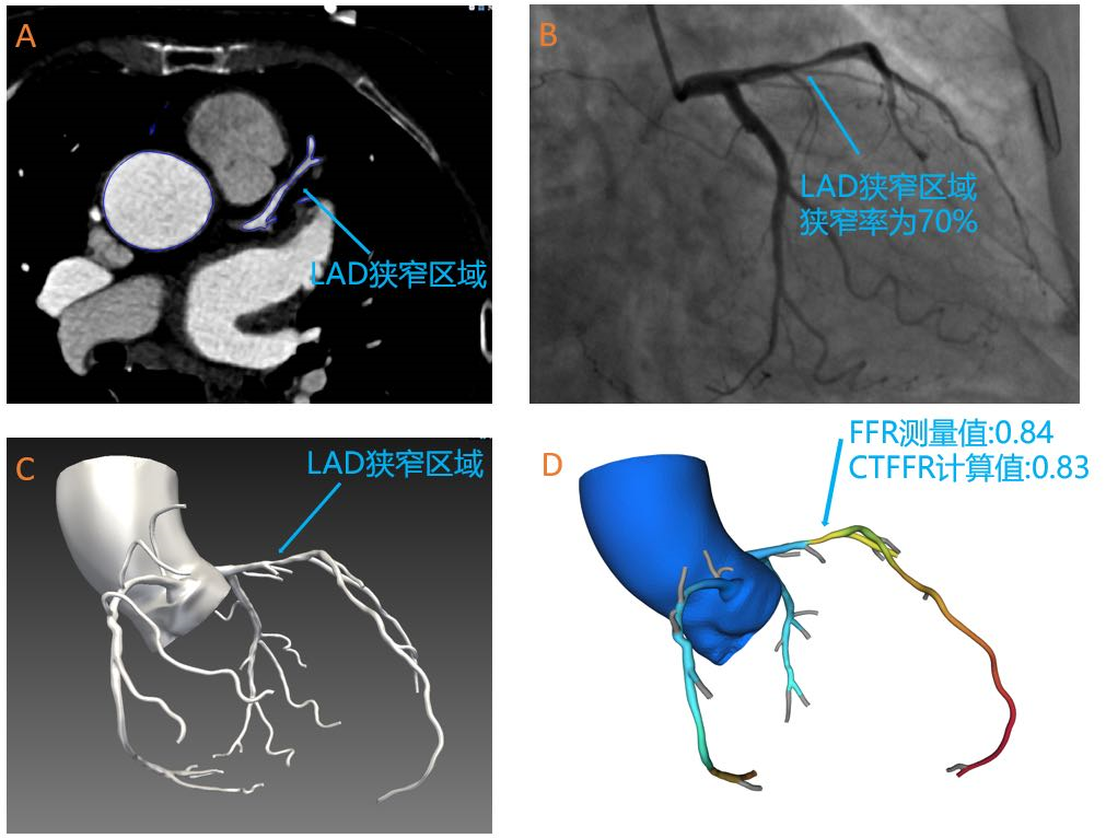 奧泰康助力睿心醫(yī)療&mdash;《冠狀動脈供血功能（CT-FFR）評估軟件》產(chǎn)品完成創(chuàng)新審評及臨床試驗(yàn)