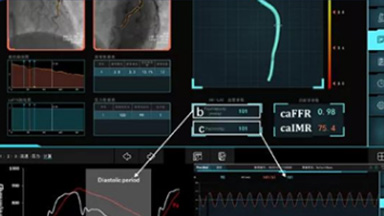 冠狀動(dòng)脈血流儲(chǔ)備分?jǐn)?shù)測(cè)量系統(tǒng)（蘇州潤邁德）